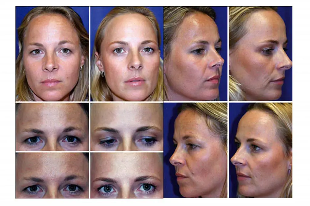 Botox Beauty Treatments Trends Safety And Real Results