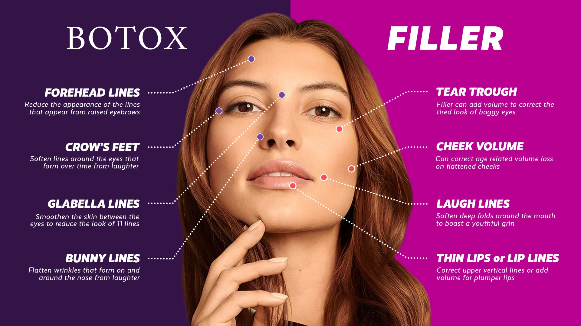 Botox Anti Aging Beauty Treatment Results Safety Guide