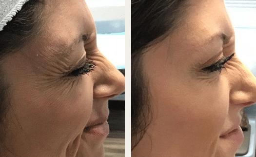 What Happens After Botox? A Look at the Healing Process