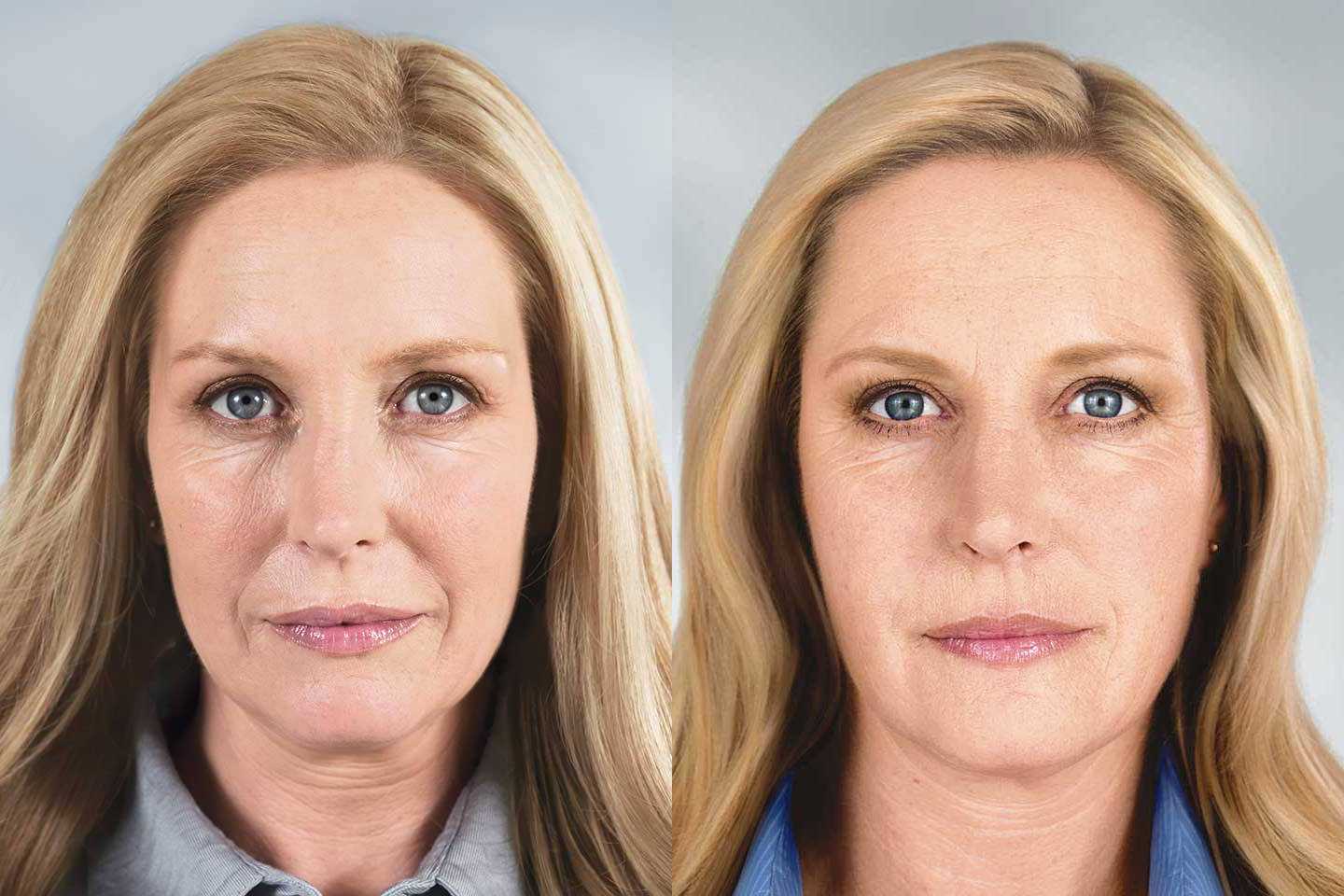 Why Botox Isn’t Just for Wrinkles: Exploring Other Uses