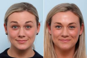 The Impact of Botox on Facial Expression and Natural Beauty