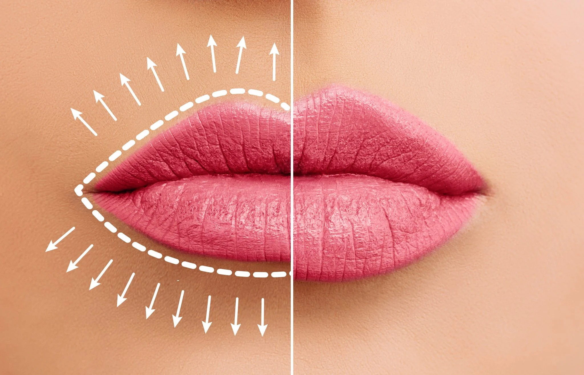Lip Flip Botox: Bibir Tampak Penuh Tanpa Filler