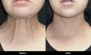 botox-leher-solusi-praktis-kencangkan-kulit-tanpa-operasi