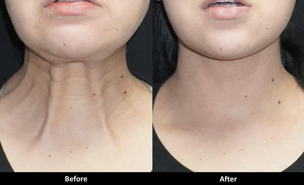 botox-leher-solusi-praktis-kencangkan-kulit-tanpa-operasi